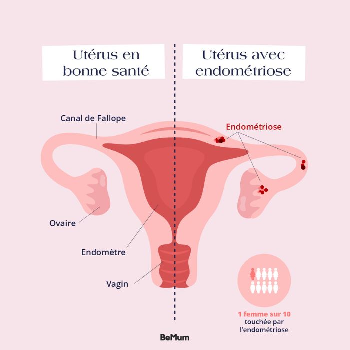 Les causes de l’endométriose