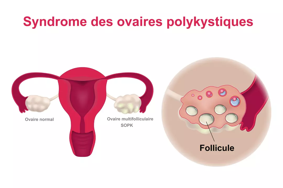 SOPK : Ovaires polykystiques
