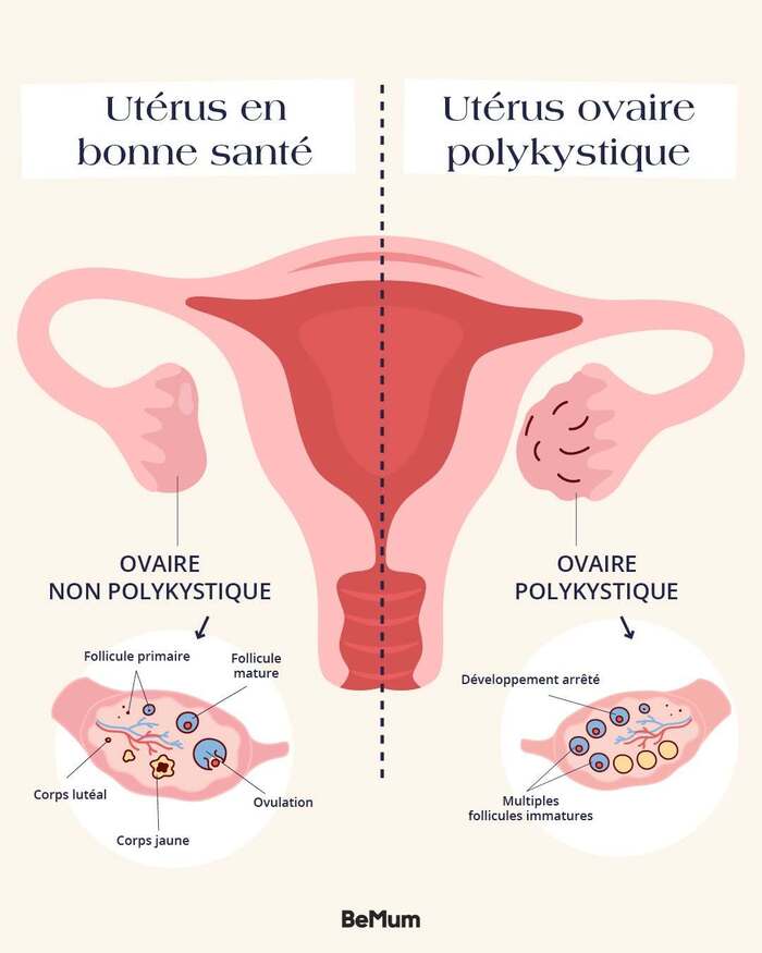 Les symptômes du SOPK