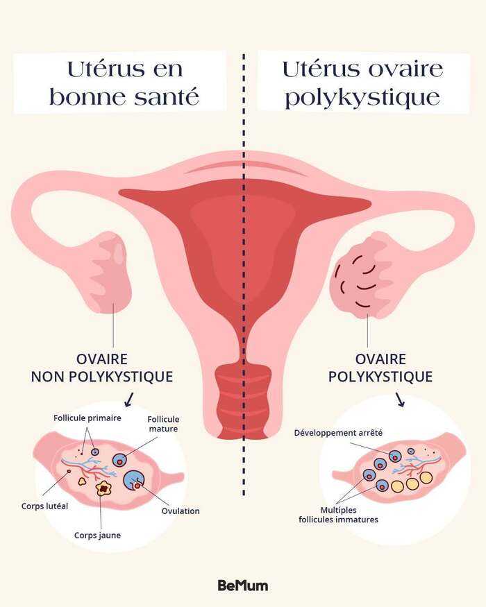 Les symptômes du SOPK